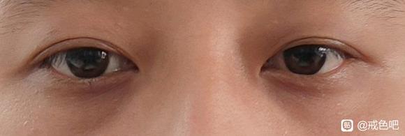 ”戒色多久黑眼圈才能恢复，眼周还有小皱纹