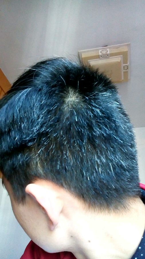 ”【问题求助】我的白发！淫邪已戒！！但是白发太影响外表了！特别烦