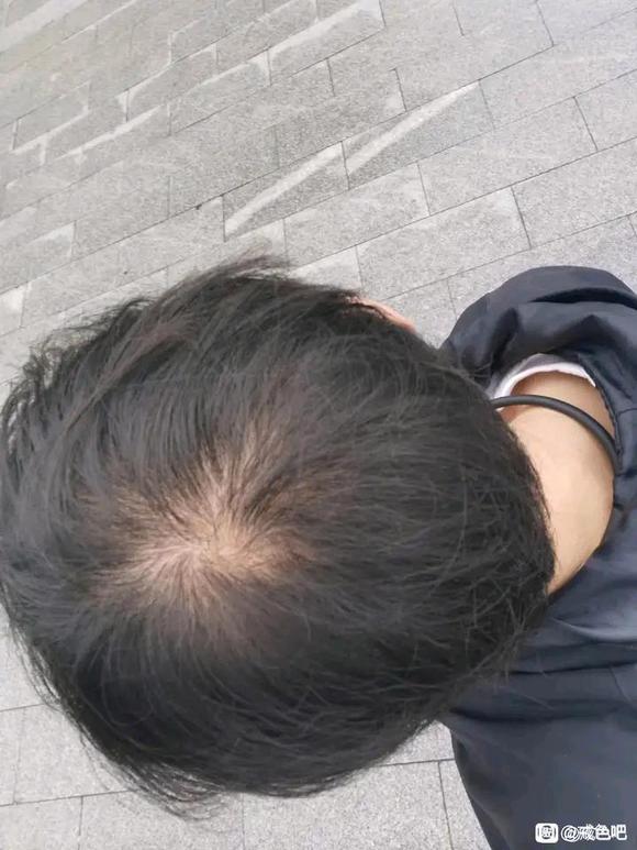 ”脱发好严重啊！彻底戒掉sy多久能恢复啊？我才22岁
