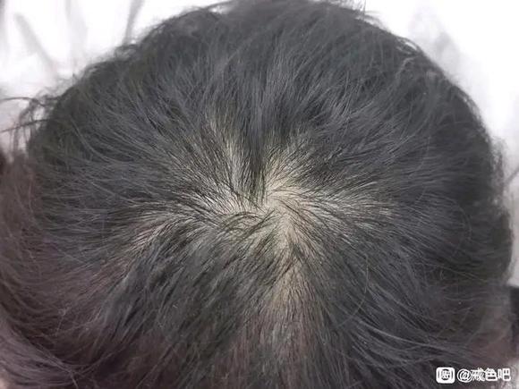 ”脱发好严重啊！彻底戒掉sy多久能恢复啊？我才22岁