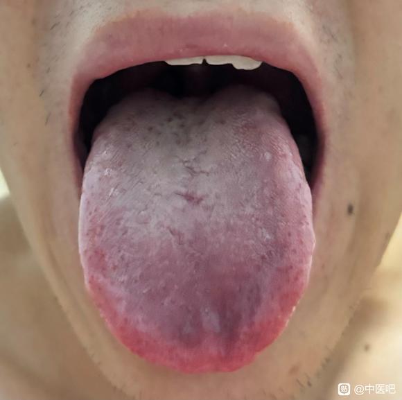 ”【医案讨论】求大神指导！广告勿扰