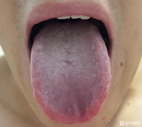 ”【医案讨论】求大神指导！广告勿扰