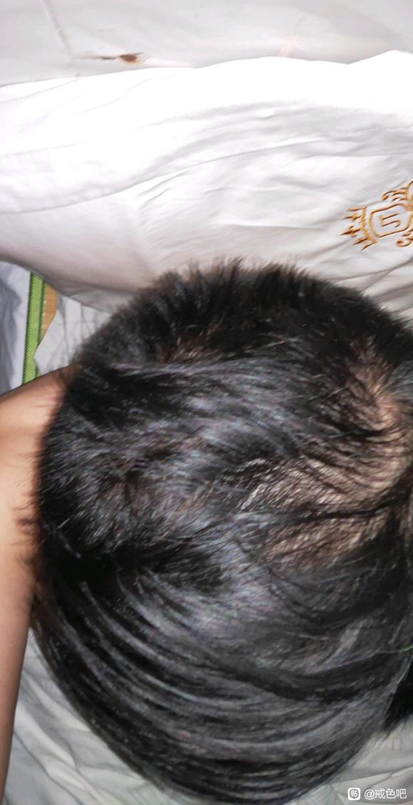 ”现在开始脱发