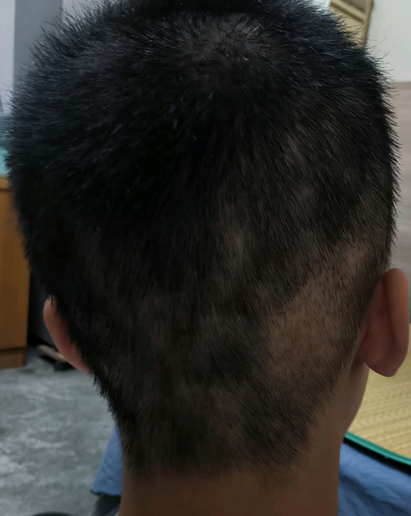 ”现在开始脱发