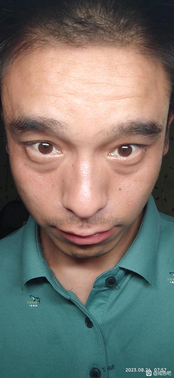 ”眼袋黑眼圈很严重