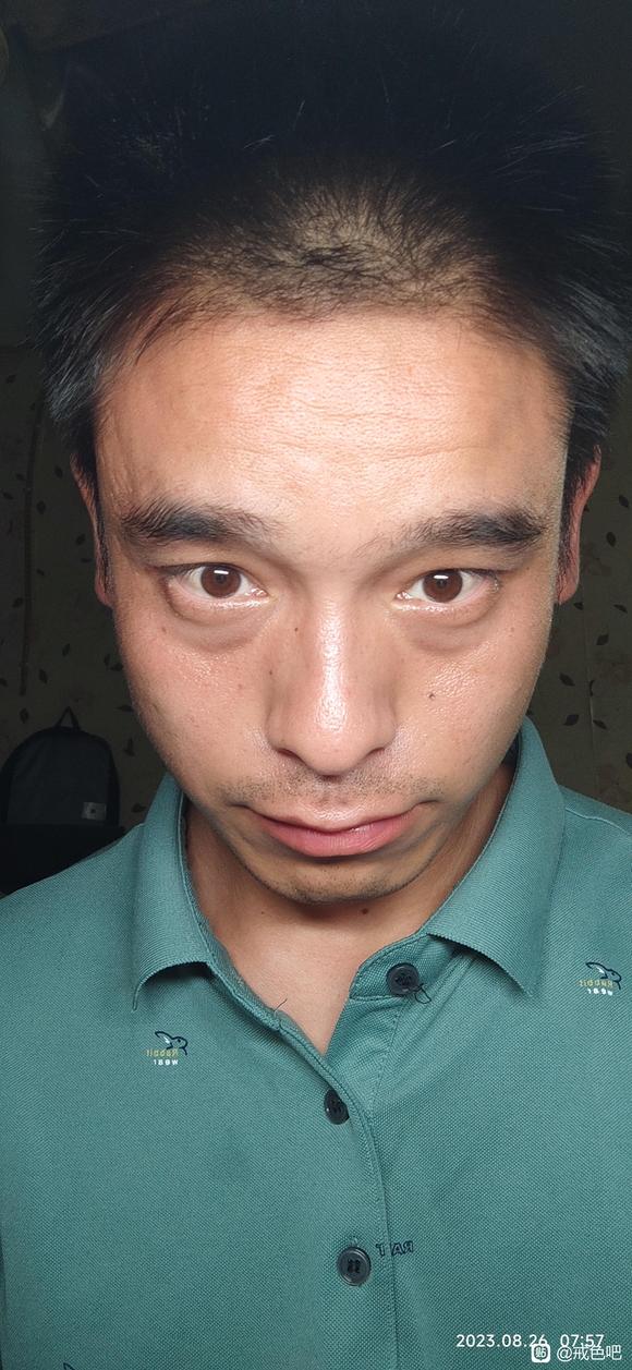 ”眼袋黑眼圈很严重