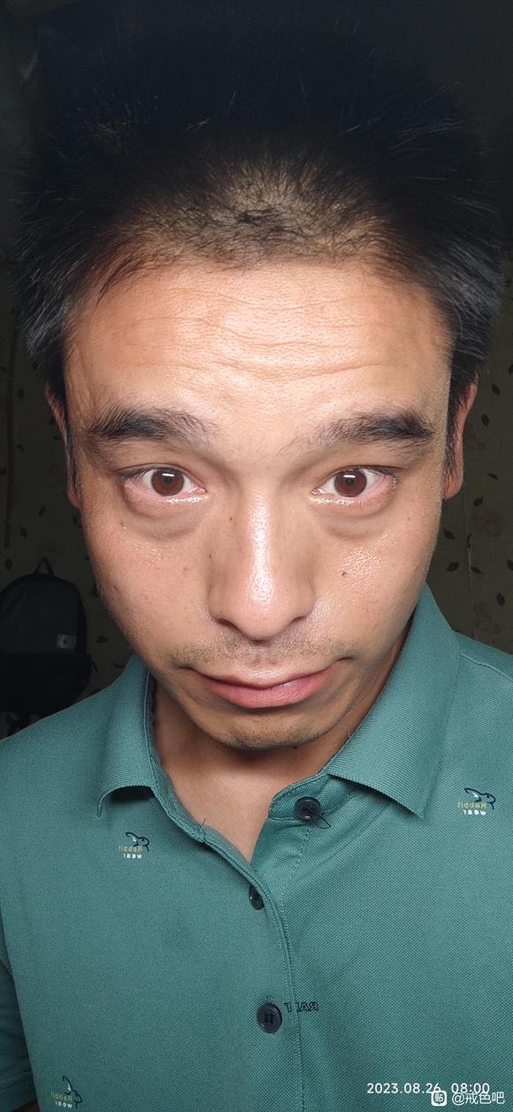 ”眼袋黑眼圈很严重