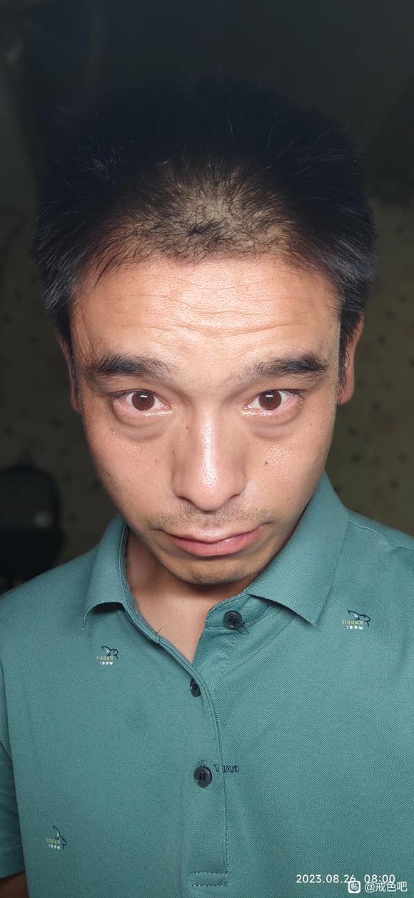 ”眼袋黑眼圈很严重