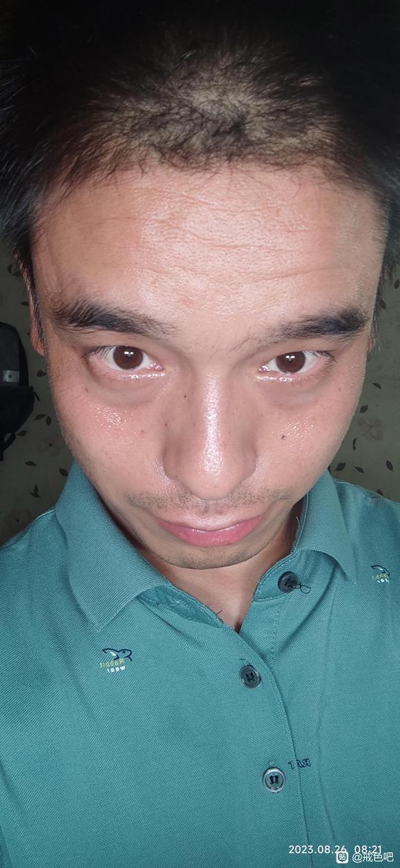 ”眼袋黑眼圈很严重