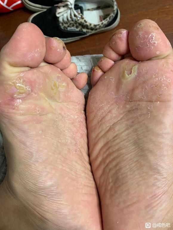 ”sy会导致脚气吗