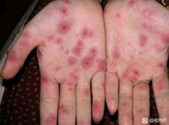 ”一次中招，一位Hiv晚期患者的血泪忏悔！！！