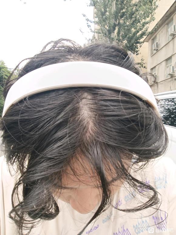 ”师兄们我这脱发怎么办