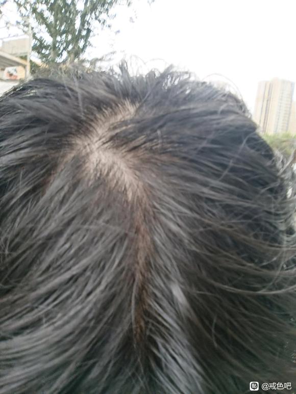 ”师兄们我这脱发怎么办