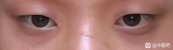 ”【发帖先看置顶】黑眼圈求助！！！