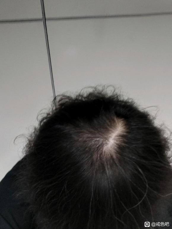 ”手淫3年了，频率一直很高，头发很稀疏，戒掉还可以养回来么