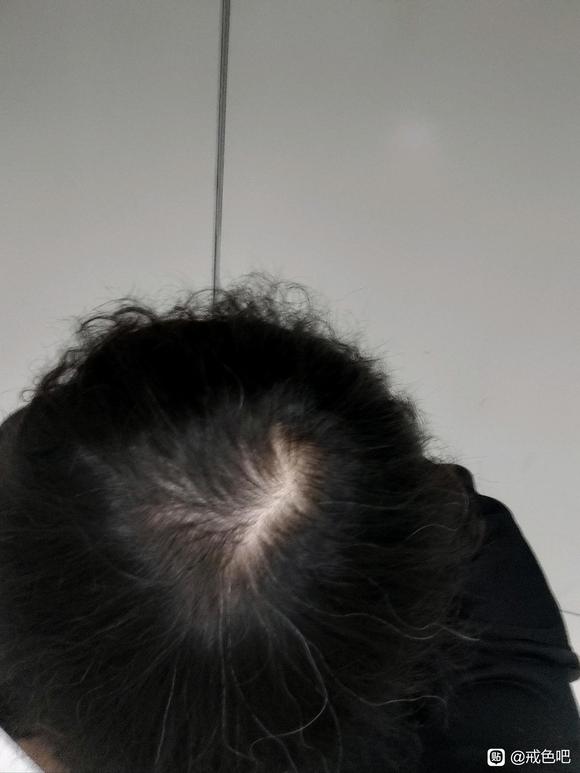 ”手淫3年了，频率一直很高，头发很稀疏，戒掉还可以养回来么