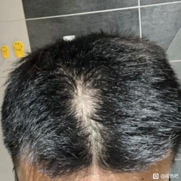 ”头发脱发成这样