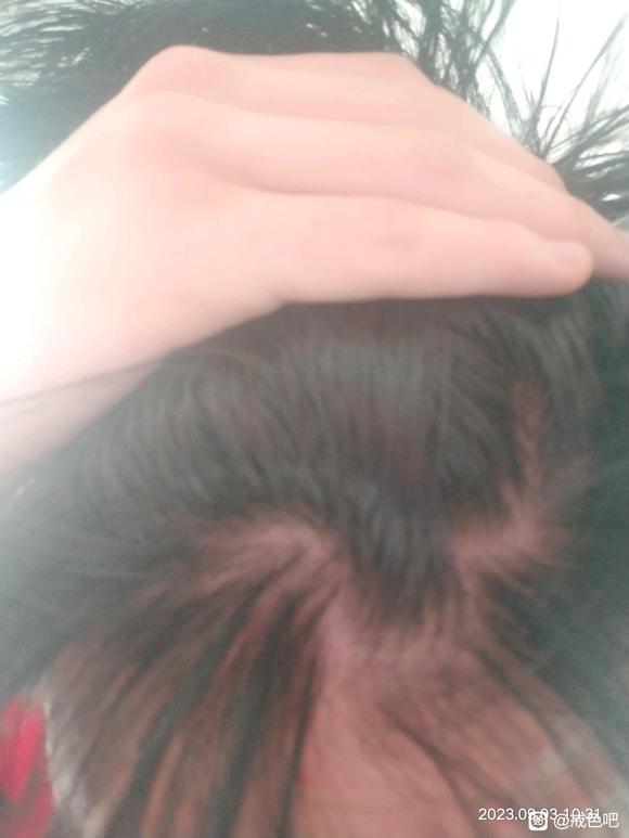 ”有兄弟帮我看看我这脱发严不严，谢谢