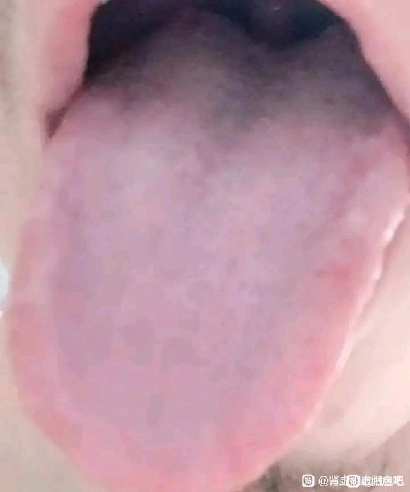 ”是肾阴虚还是肾阳虚还是两虚，严不严重