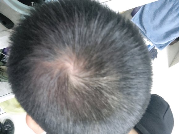 ”脱发很严重，求助啊