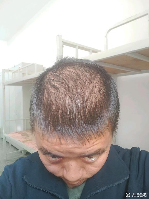 ”这种脱发还有救吗，看起来像四十岁