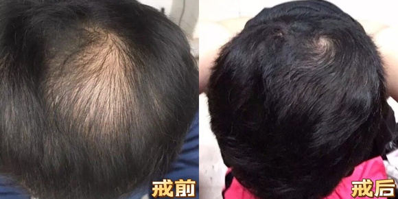 ”戒色5个月，头发长出来