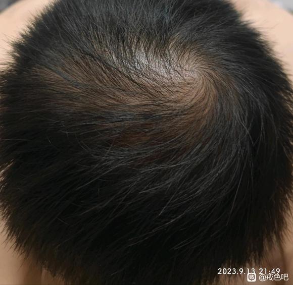 ”戒色5个月，头发长出来