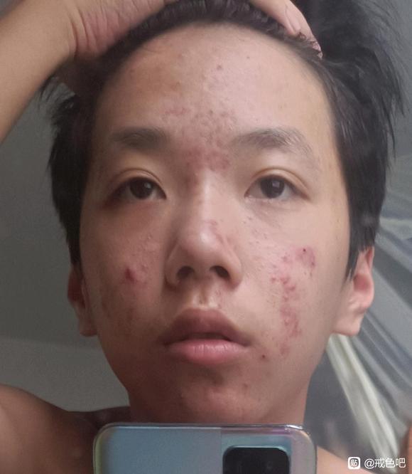 ”这种痘痘要jie多久才能好啊