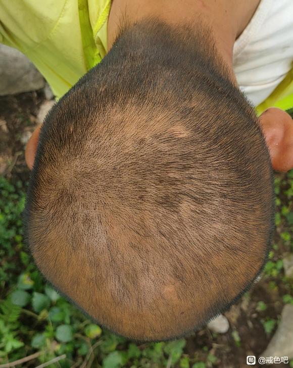 ”短短一年就秃顶了！咋办？