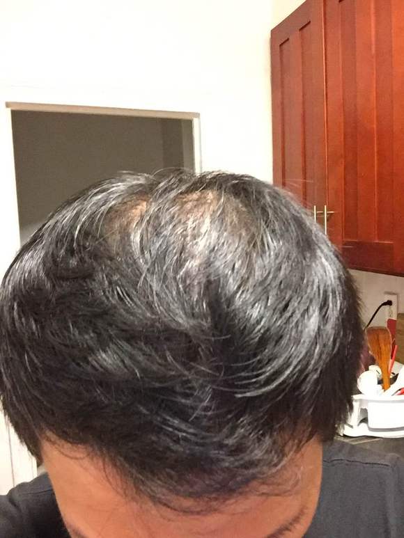 ”11年撸龄.脂溢性脱发.快秃顶了.一天不洗超油.肾阴虚.戒不