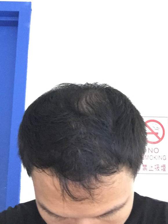 ”11年撸龄.脂溢性脱发.快秃顶了.一天不洗超油.肾阴虚.戒不