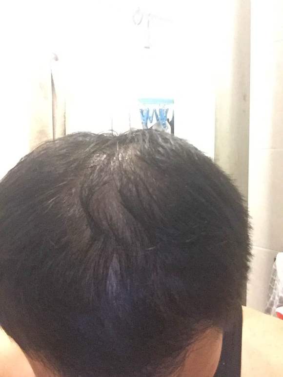 ”11年撸龄.脂溢性脱发.快秃顶了.一天不洗超油.肾阴虚.戒不