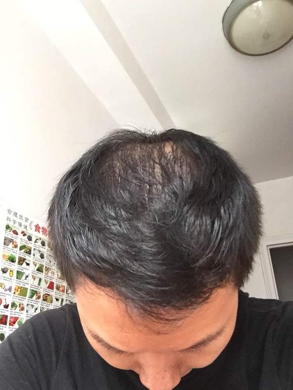”11年撸龄.脂溢性脱发.快秃顶了.一天不洗超油.肾阴虚.戒不
