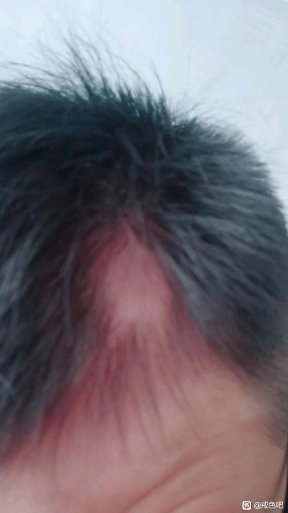 ”头发掉一块