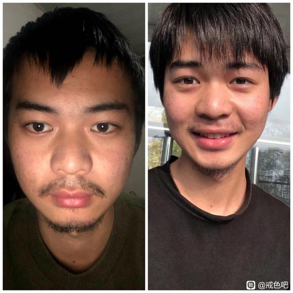 ”sy导致脸部变形