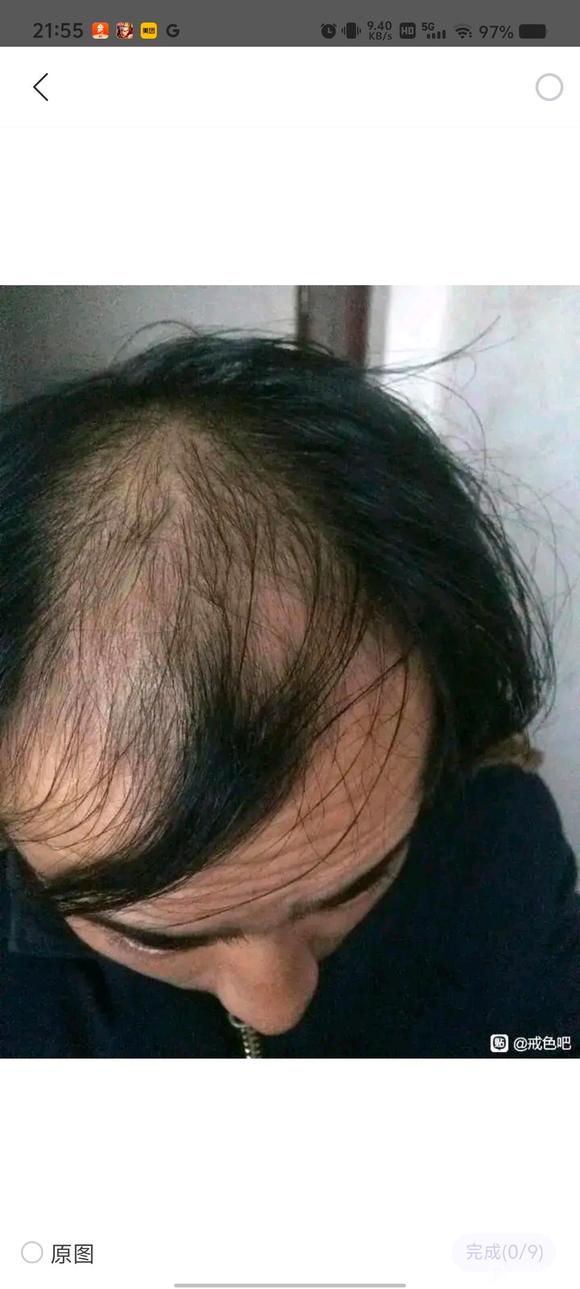 ”脱发问题求助