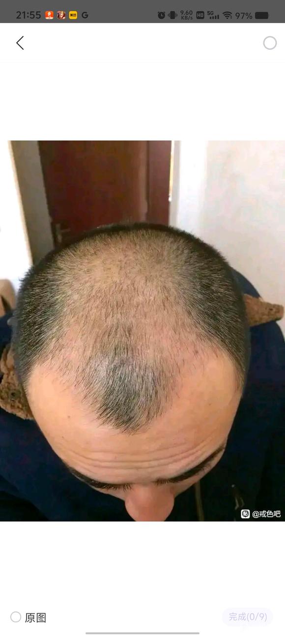 ”脱发问题求助