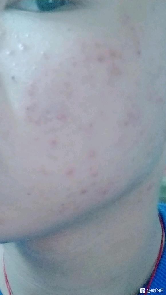 ”我脸上的青春痘好影响我的外貌，还有眉毛稀疏。