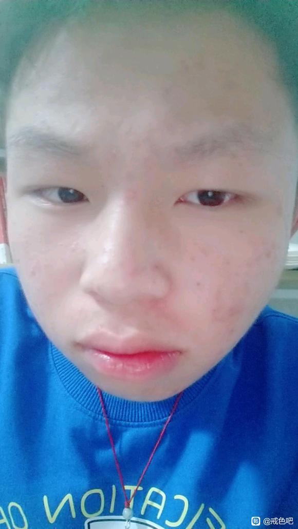 ”我脸上的青春痘好影响我的外貌，还有眉毛稀疏。
