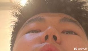 ”眼睛这块是凹陷吗