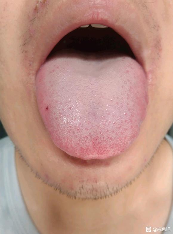 ”自汗多汗症怎么治