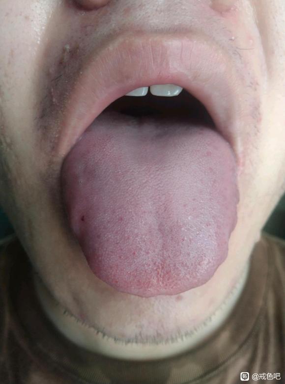 ”自汗多汗症怎么治