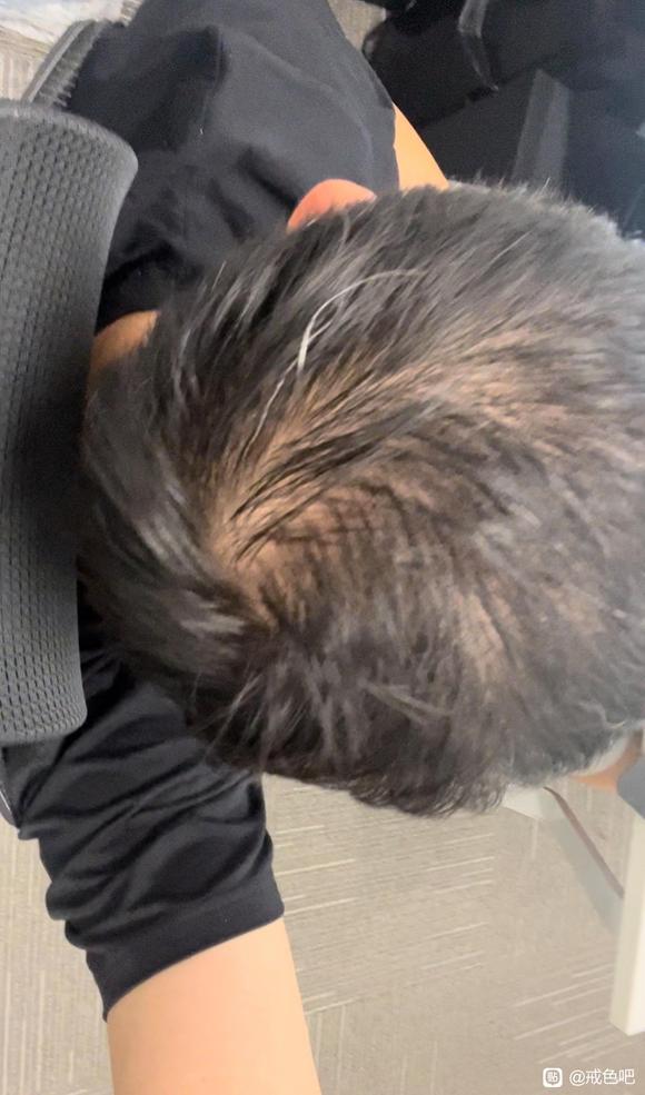 ”秃顶很严重了，可以恢复吗