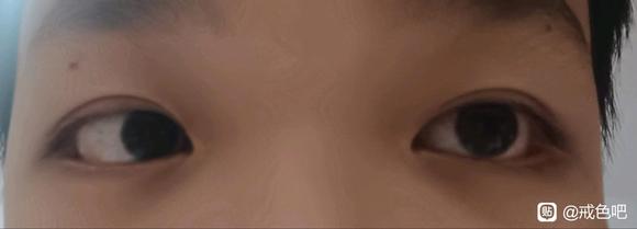 ”各位老哥这眼睛算浮肿吗