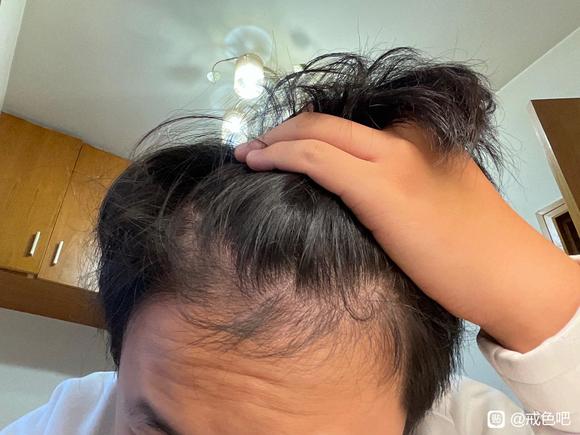”这个发际线还有救吗