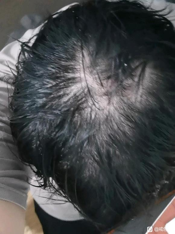 ”我这脱发还有救吗