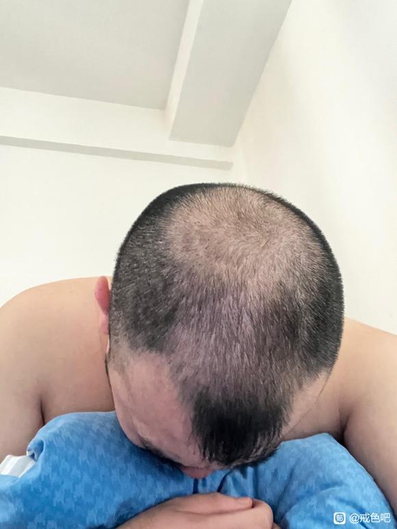 ”98年，13年历史，头发已经没救了