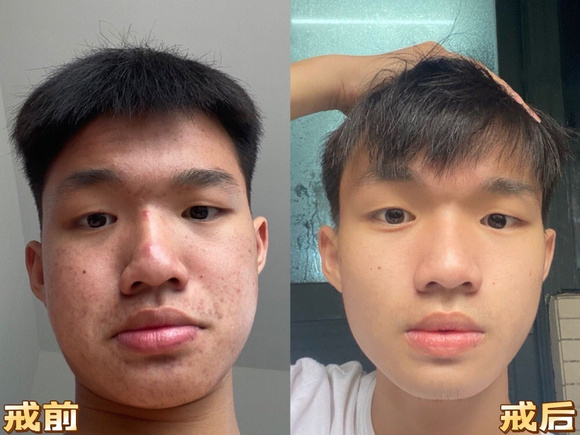 ”戒色后，痘痘消失了