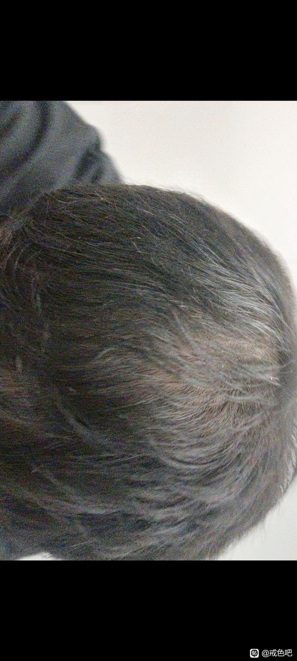 ”24岁脱发到这种样子了