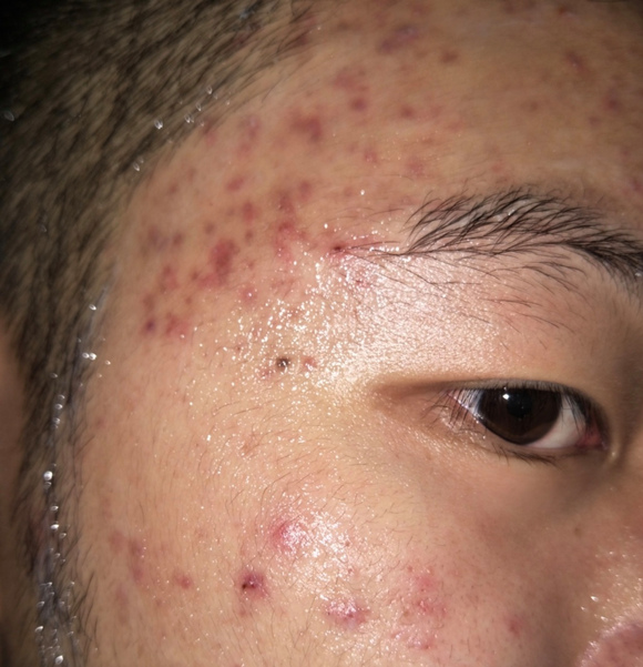 ”新戒友之痘痘疑问